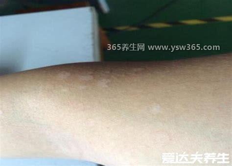 真实的早期花斑癣图片,白色或褐色的斑块(痒不舒服)