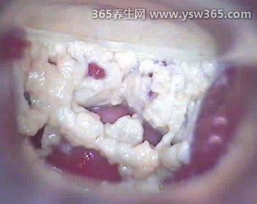 女生下面抠出很多白色豆腐渣什么原因,是霉菌性阴道炎的典型症状