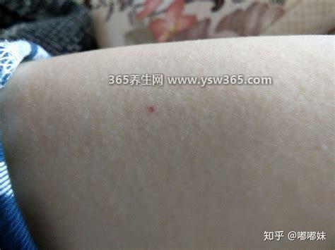朱砂痣长什么样,颜色是浅红色或者深红色很少见
