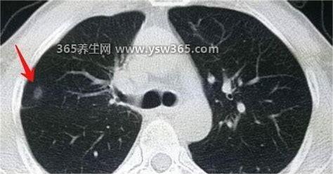 三个征兆说明已有肺癌,长期咳嗽痰中带血/胸闷要及时治疗