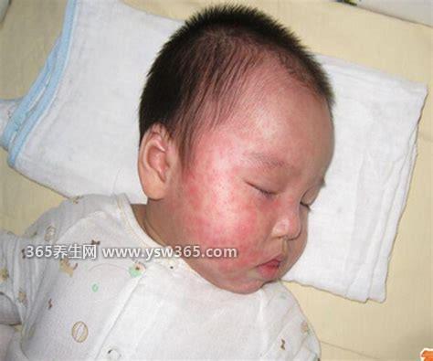 麻疹刚开始的样子图片和症状,2-3天后会长出鲜红的斑点