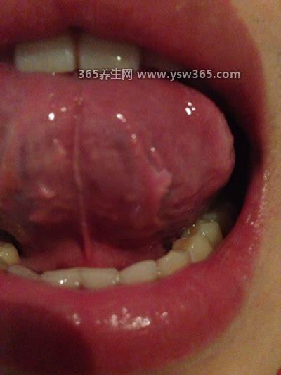 口腔舌系带疣体图片,类似于菜花或者鸡冠花小豆粒那么大