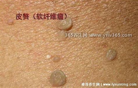 皮赘和疣的区别图片,丝状疣表面很粗糙无蒂无根/摸起来很硬