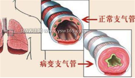 支气管炎偏方三天见效,生姜胡萝卜汁/冰糖/雪梨水都是常见食材