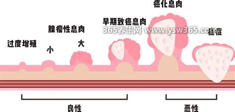 癌症晚期死亡八个过程,第一个过程是长期昏睡