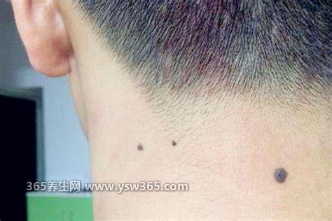 脖子后面有痣代表什么,并不代表什么(但要注意有患癌的风险)