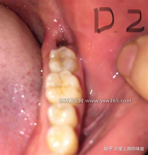 拔智齿几天才能恢复正常,7天后就恢复正常了(每个人不一样)