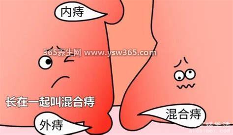 内外痔疮最佳的自愈方法,用无花果叶熏洗(偏方)适用于外痔