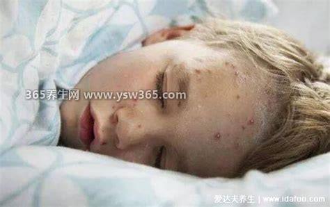 6种常见新生婴儿皮肤红疹图片,长红疹的原因有很多/湿疹/荨麻疹等等