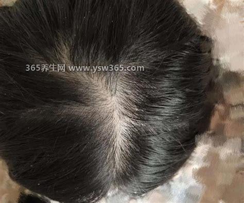 掉头发严重是身体出现了什么问题,可能是内分泌失调导致脱发