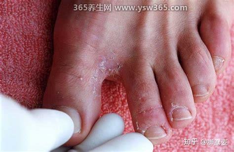 脚气图片水泡型初期症状,有小水疱融合成大疱(不可搔抓或刺破)