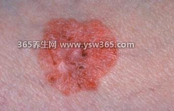 皮肤癌早期症状图片,皮肤容易出血结痂/出现异常痣