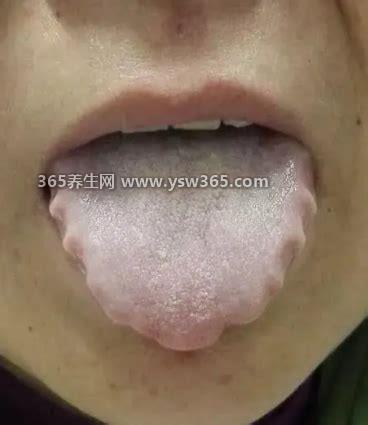 内伤湿滞,是指由于全身疲劳而产生的湿阻引起的脾胃虚弱等