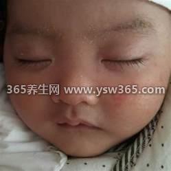 湿疹和热疹的区别图片,发病时间/治疗方法/症状都不一样