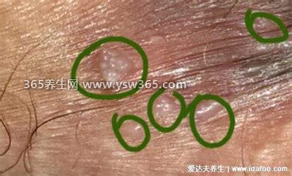 男女初期小疣体图片,属于一种X病传染性很强
