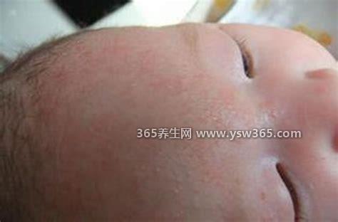 痱子症状图片,常见有白色痱子/红色痱子/脓性痱子三种