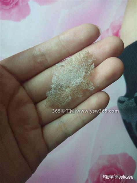 头皮上有白色大片的皮是怎么回事图片,有三种可能的情况