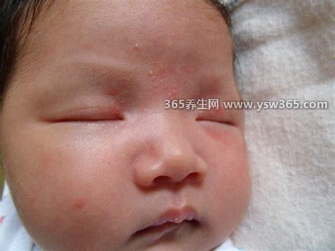 宝宝婴儿湿疹图片,主要分布在脸颊/额头/下巴和耳后