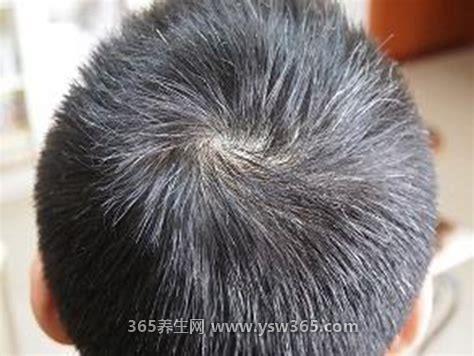 三个部位长白发最危险,额头/后脑勺/太阳穴可能与脾胃疾病有关