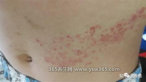艾滋病一开始的皮肤图症状图片,皮肤会出现红色或红棕色的皮疹