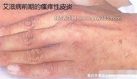 一个月不发烧基本排除艾滋病,这种说法不准确/不要被误导