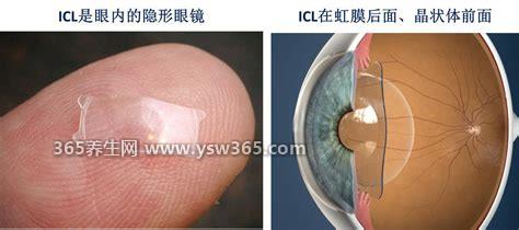 ICL人工晶体植入价格费用是多少钱,在28000元到35000元之间
