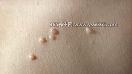 病毒性软疣的症状图片,发生在私处/发病的位置会有小丘疹