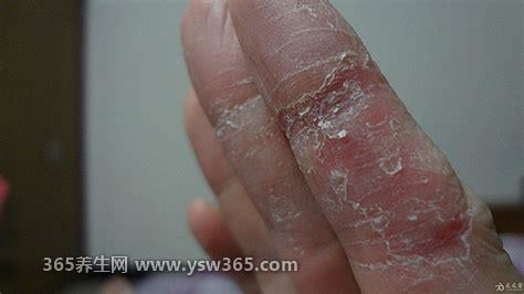 各种常见真菌皮肤病图片及症状对照大全,大部分感染在皮肤上