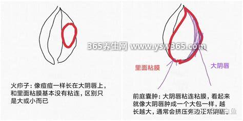 前庭大腺囊肿图片和症状,大多是生活不洁/反复YD炎症引起的