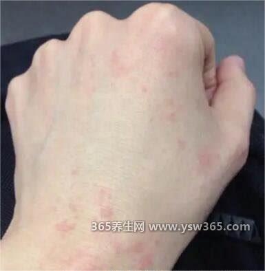 白血病初期针孔小红点图片和症状,像皮疹一样的针头大小