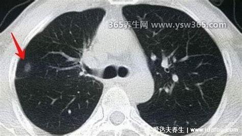 男女性肺癌晚期最怕三个征兆,声音嘶哑/咳嗽出血/身体多部位疼痛