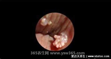 尖锐初期米粒状图片,一般好发于外生殖器和肛周/呈粉红色