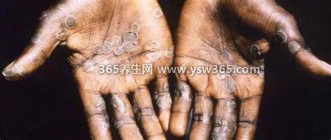 猴痘症状图片猴痘患者图片,症状类似于天花/通过血液和体液传播