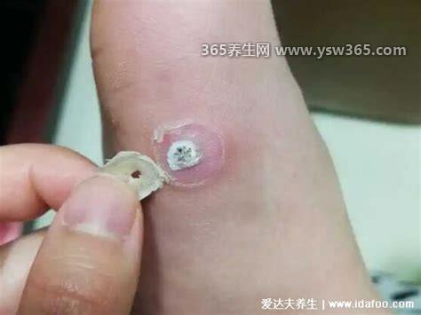 鸡眼自己脱落小妙招,可以使用低浓度水杨酸几次后会自行脱落