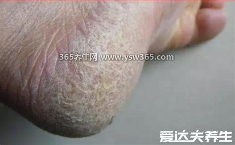 三大脚癣图片,分为鳞状角化型/水泡型/糜烂型脚癣