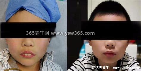 切除腺样体后悔到家了,很多孩子术后会免疫力下降