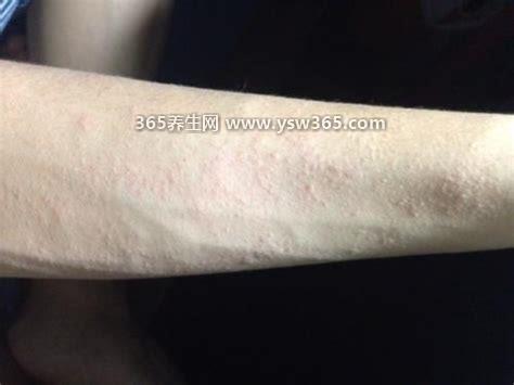 早期艾滋病身上起疙瘩图片,可表现为普通皮疹/带状阵列/湿疹等