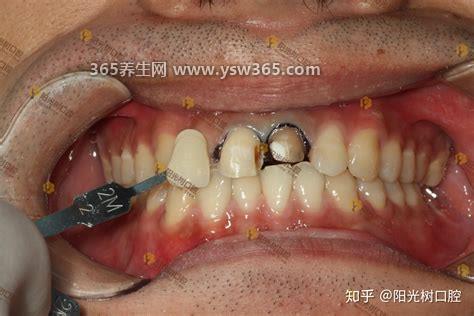 烤瓷牙的危害和副作用,如果技术不精湛会有一些缝隙