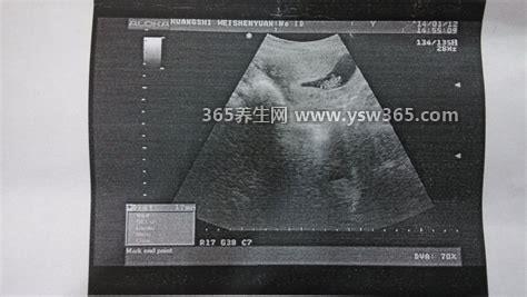 其实看孕囊很准,孕囊的大小能反映出是否正常发育