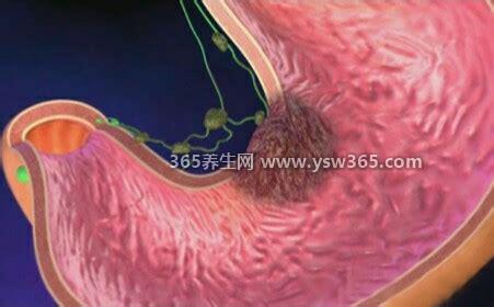 胃癌早期有三处痛,上腹部痛/吞咽疼痛/背痛(尽快检查)