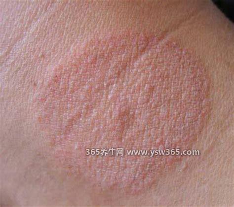 体癣图片初期症状,皮肤表面出现红斑丘疹/并迅速向四周扩散