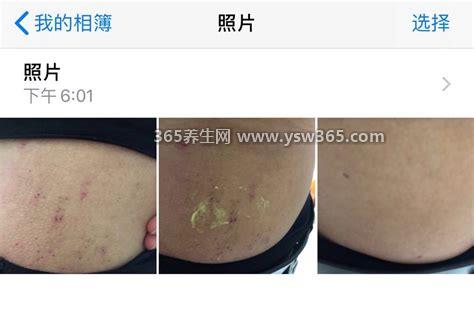 湿疹最怕一个克星3个土方法,马齿苋煮熟洗净湿敷患处可以止痒