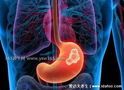 女性胃癌早期有三处痛,大部分在早期是可以无症状的