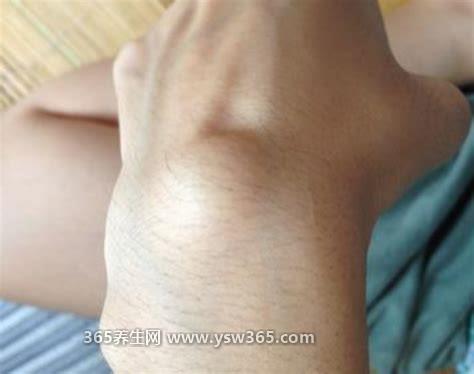 手腕腱鞘囊肿图片,是一种出现在关节附近的囊性肿块