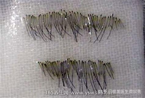 5000个毛囊植发的价格,大概要2万左右/医院价格都不一样