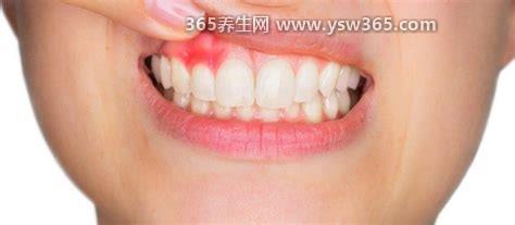 牙龈肿痛吃什么药快速消肿止痛,阿莫西林/头孢/甲硝唑/奥硝唑等消炎药