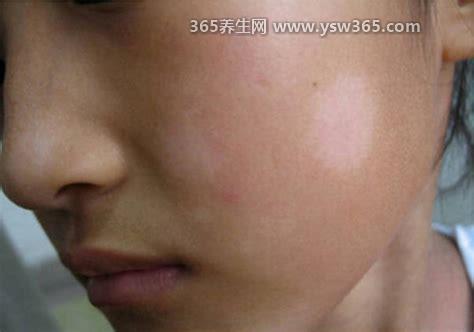 女孩白斑最初期的图片,会发现身体上有白色的斑点或者斑块