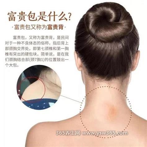 富贵包怎么消除及形成的原因,原因主要和平时的生活习惯有关