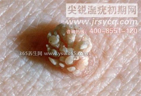 女性菜花状疣初期图片早期图片,发生在私处刚开始可能是小丘疹
