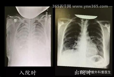 什么人容易得白肺病,老年人/新冠肺炎感染者/长时间卧床的人